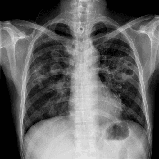 Chest X-ray